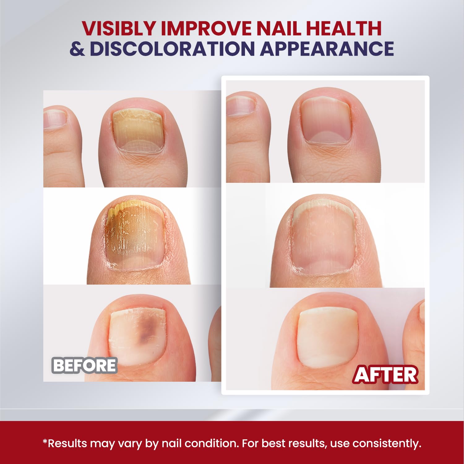 Treatonic Toenail Fungus Treatment Extra Strength: Antifungal Repair Solution with 25% Undecylenic Acid