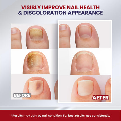 Treatonic Toenail Fungus Treatment Extra Strength: Antifungal Repair Solution with 25% Undecylenic Acid