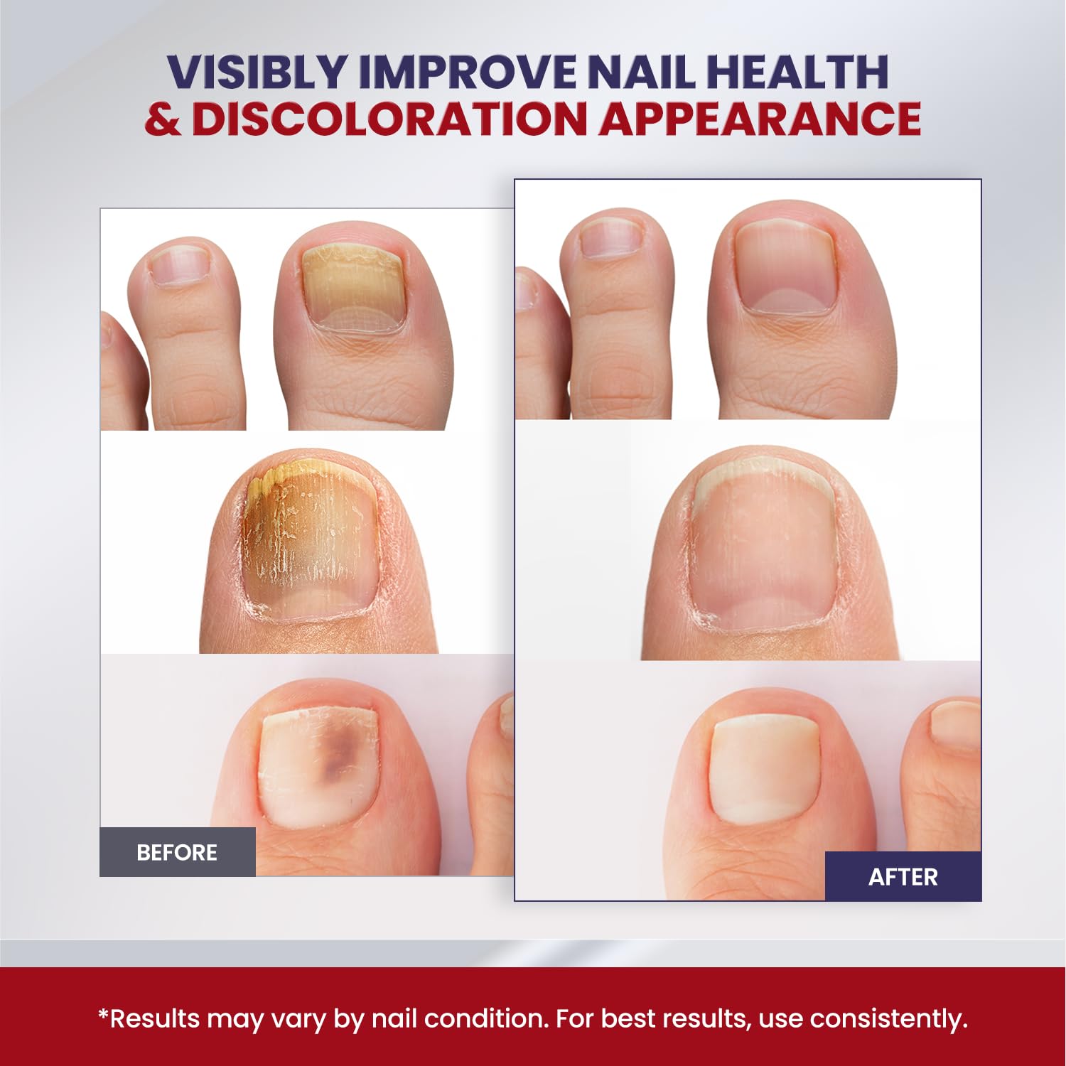 Treatonic Toenail Fungal Nail Patches: Nighttime Renewal Nail Repair Patch (32Pcs)