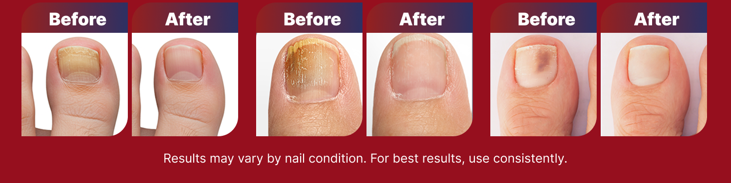 Before and after photos from three real Treatonic customers showing clearer, healthier-looking toenails
